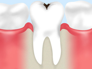 虫歯の基礎知識