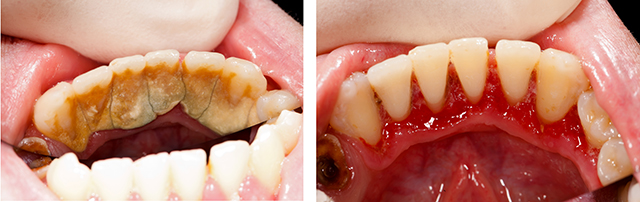 歯周病治療の注意点