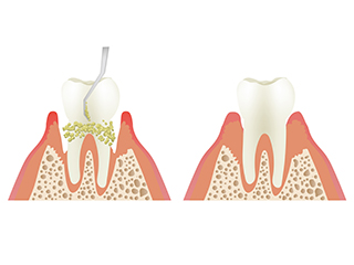 【2】歯周ポケット内の歯石の除去