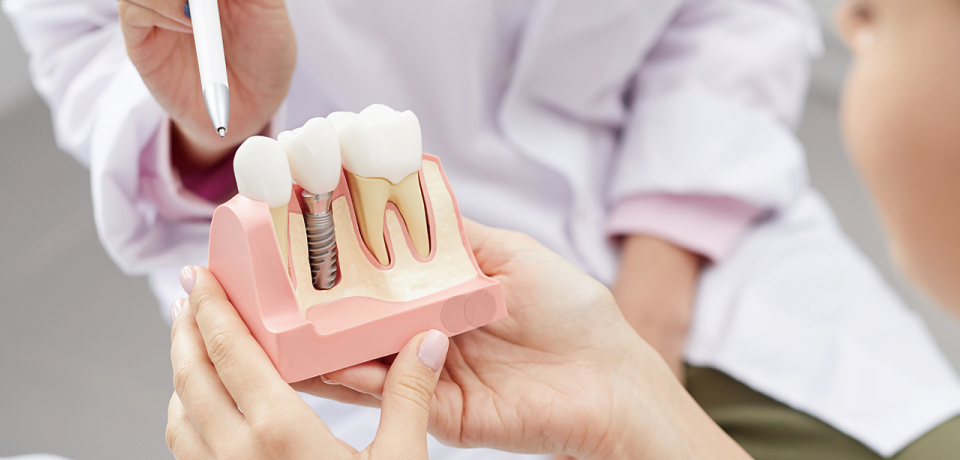 インプラントによる歯の補填は残る自然歯を守ることにも繋がります