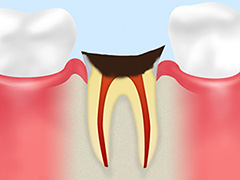 【C4】歯の根に達した虫歯