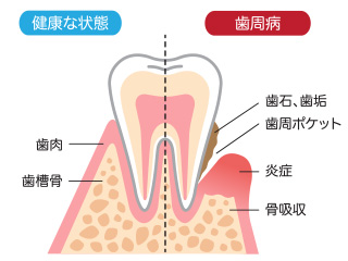 歯周病の特徴